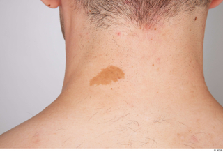 Serban birthmarks nude skin 0001.jpg